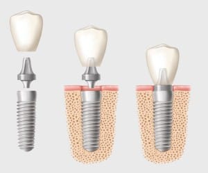 Implant dentar 34 bucuresti