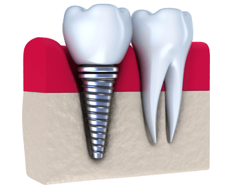 pdm_dental-implant-example_thumb