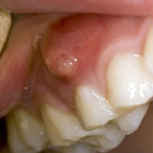 abces dentar