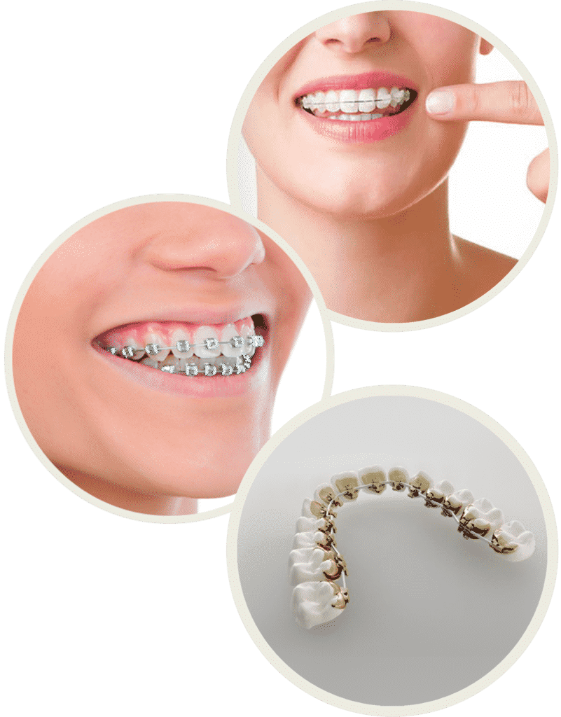 Allegations toothache praise Aparat dentar • Pret • Metalic sau Invizibil in 2021 ? [Plata in rate]