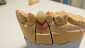 Implant dentar si Implanturi Dentare - Ghid Complet | DELTA CLINIC DENT