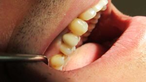 Implant dentar si Implanturi Dentare - Ghid Complet | DELTA CLINIC DENT