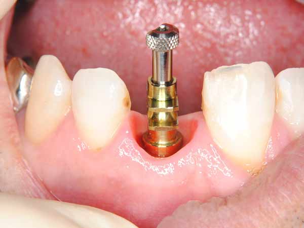 pret implant dentar 2018