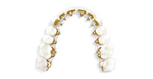 aparat dentar ortodontic lingual