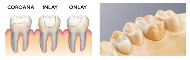 inlay onlay coroane dentare bucuresti