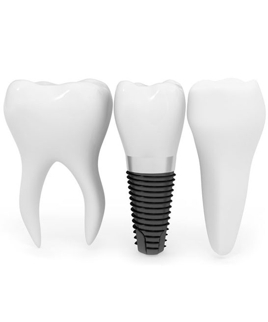 implant-dentar-pret-v2-promotie-300-b