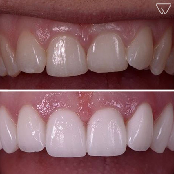 Fatete dentare avantaje si dezavantaje | Delta Clinic Dent