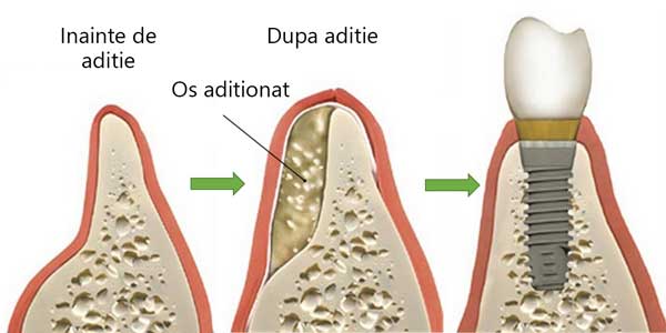 implant dentar rapid