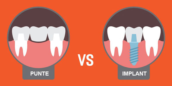 Cat costa un implant dentar vs punte dentara