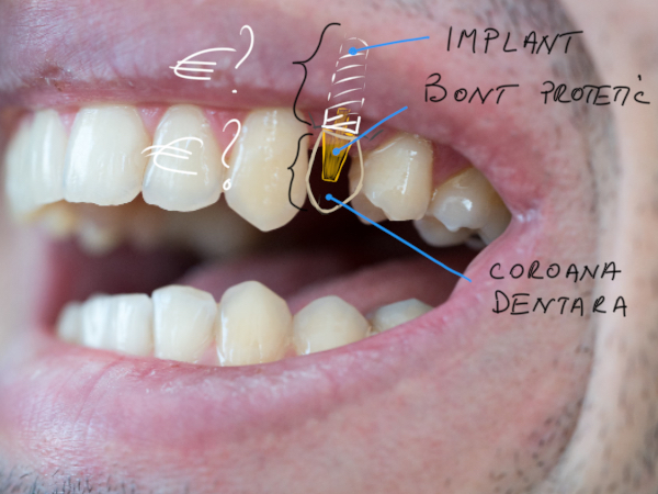 Implant dentar pret Bucuresti