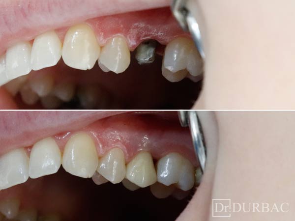 anytime surfing Preconception Coroana Dentara si Dintii din Zirconiu | Ghid complet 2022