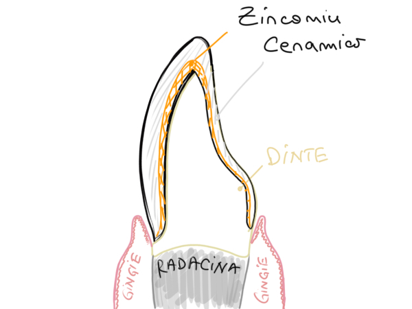 coroana dentara zirconiu ceramica