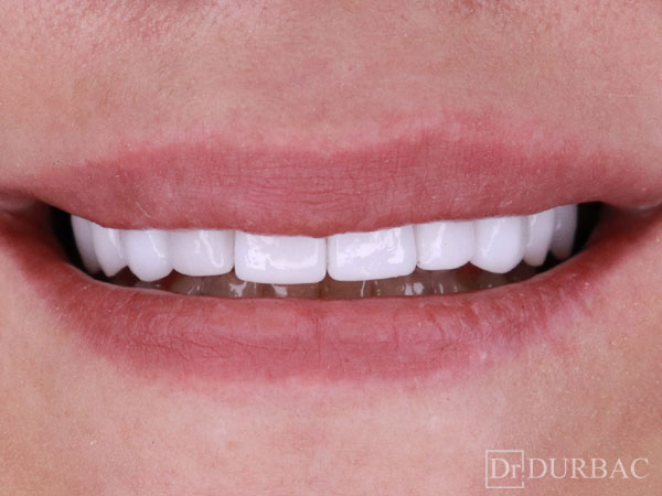 Fatete-dentare-Emax-Dupa-caz-28