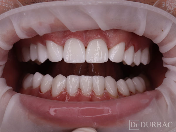 Pacient-164-fatete-dentare-Dupa-v3