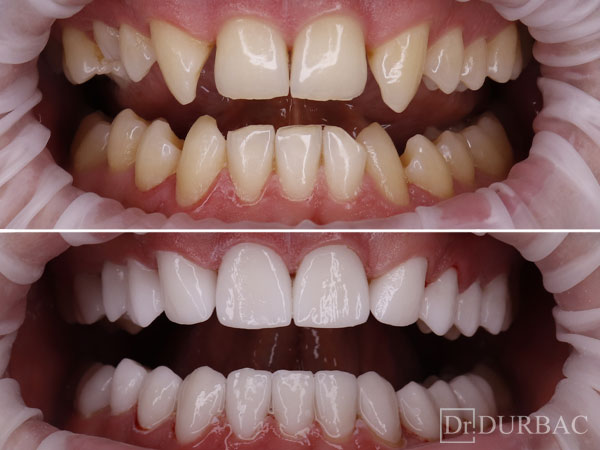 Pacient-164-fatete-dentare-inainte-si-Dupa-v3