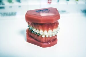 Ce avantaje si dezavantaje are un aparat dentar?