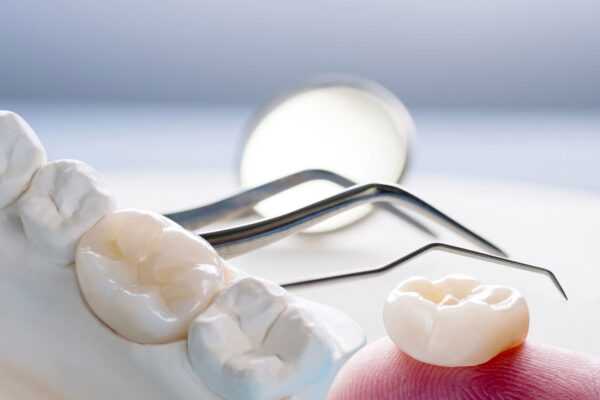 Coroana dentara zirconiu VS ceramică - Preturi & Avantaje