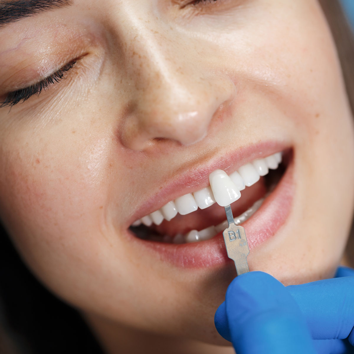 Tipuri de fatete dentare - Cum alegi fatete dentare potrivite Fatete dentare