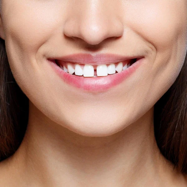 diastema-strungareata-02 Strungareata / Diastema - Ce este, cum se poate corecta